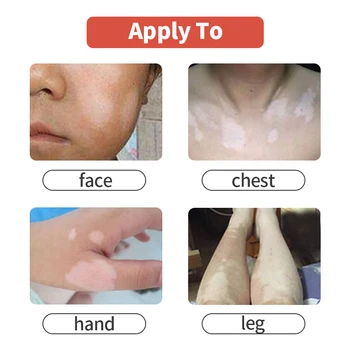 Leukoplakia Zdravljenje Bolezni Leukoplakia Bolezni Popravila Tekoče Vitiligom Kitajskih Medicinskih Pigment Melanin Spray Za Nego Kože