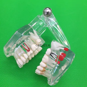 Zob Model Zobni Vsadki Bolezni Zob Model Z Obnovo Mostu Zob Zobozdravnik Za poučevanje