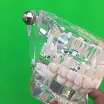Zob Model Zobni Vsadki Bolezni Zob Model Z Obnovo Mostu Zob Zobozdravnik Za poučevanje