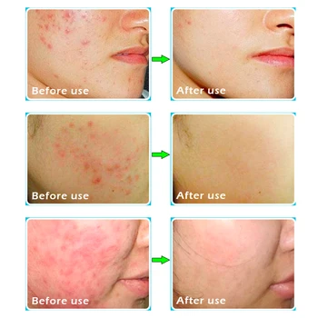 20% kisline skinoren kremo 30 g ali Medodermone 25g Akne Krema Anti Acne Scar Removal Cream Skrči Pore Obraz za Nego Kože